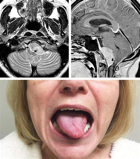 Foramen Magnum Meningioma | The Neurosurgical Atlas