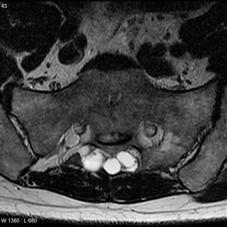 Tarlov cyst | Radiology Reference Article | Radiopaedia.org