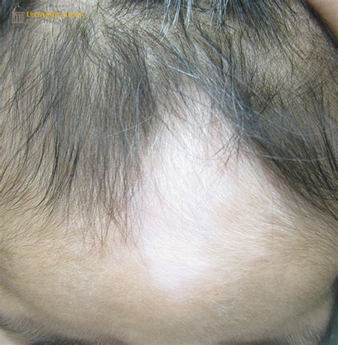 Digmented patch with white forelock on the frontal scalp. (click images ...