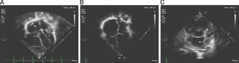 A: Apical 4-chamber view showing main thrombus arising from the left ...