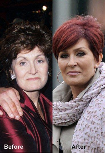 Sharon Osbourne Facelift | Celebrity Face-Lift Before And After ...