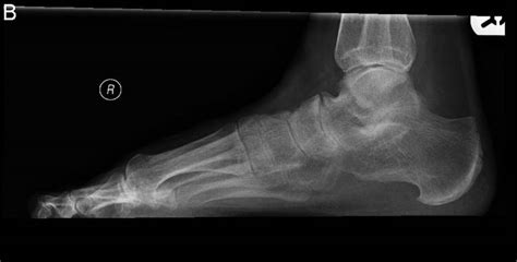 Subtalar joint | The Foot and Ankle Online Journal