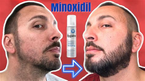 Minoxidil Beard Before And After : Hypertrichosis Minoxidil | Indrisiak