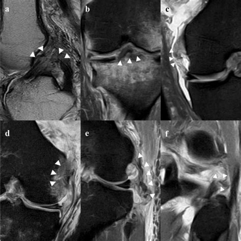 Preoperative MRI of the multiple ligaments knee injuries/knee ...