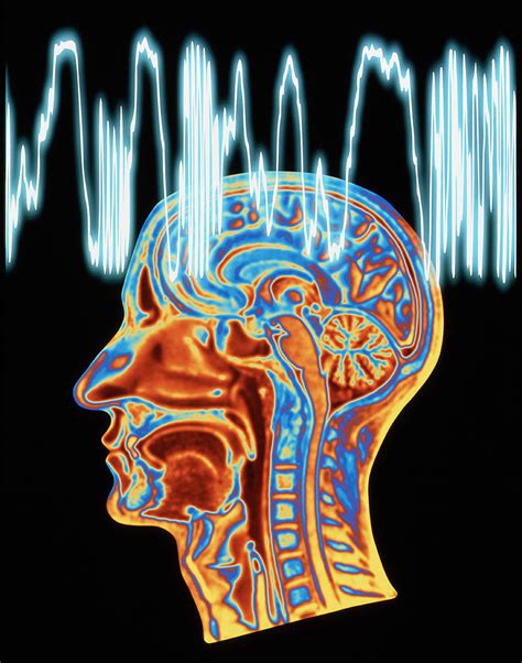 Epilepsy: Mri Brain Scan And Eeg Trace Photograph by Pasieka