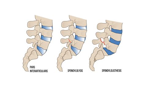 Spondylolysis Vs Spondylolisthesis