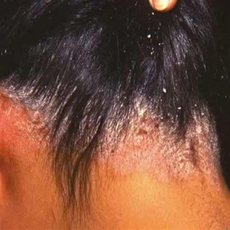 Know The Signs - 6 Scalp Problems We May Have To Deal With At Some Point In Our Life