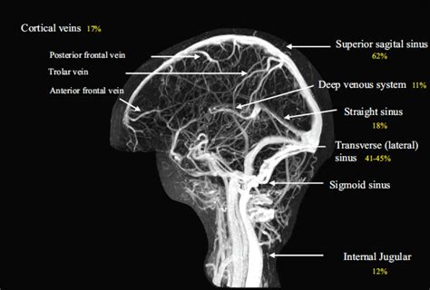 Cerebral Venous Thrombosis – Core EM