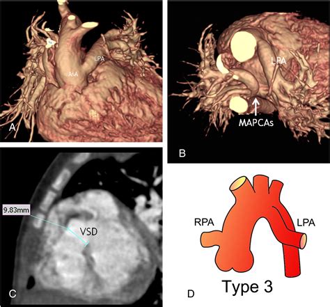 3D MDCT angiography for the preoperative assessment of truncus arteriosus - Clinical Imaging