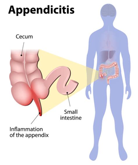 Appendicitis Closeup Appendix Inflammation Vector Illustration ...