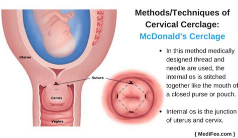 Cervical Cerclage Surgery: Methods, Procedures and Risks (2023)