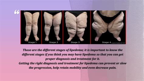 PPT - What are the Different Stages of Lipedema? PowerPoint Presentation - ID:10622819