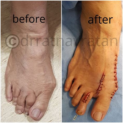 A Case of a 55-Year-old Woman with a Severe Deformity of Great Toe - Dr ...