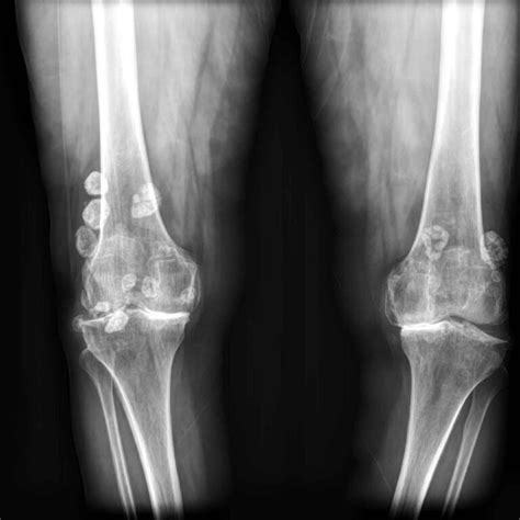 Synovial osteochondromatosis causes, symptoms, diagnosis, treatment & prognosis