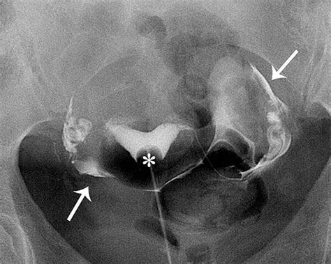 Hysterosalpingogram (HSG) Test: How to Prepare | UCSF Radiology