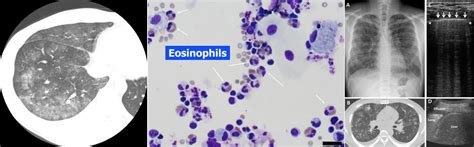 Acute Eosinophilic Pneumonia (AEP) - EMCrit Project