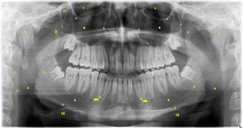 Macrodontia radiografia