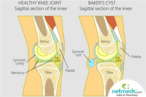 Get 28: Baker's Cyst Ultrasound Anatomy