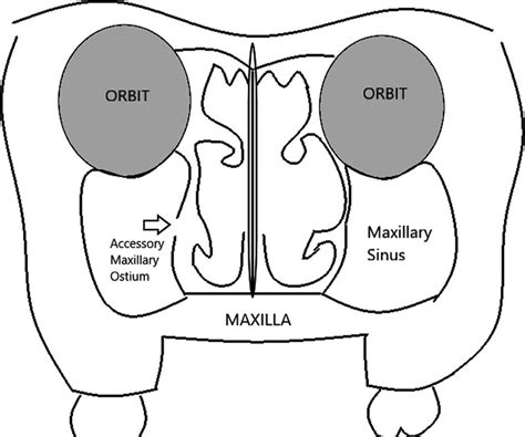 Ostium Maxillary Sinus