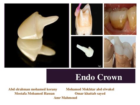 Endo crown