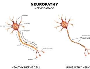 Small Fiber Neuropathy Symptoms and Causes