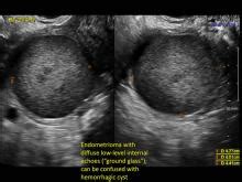 Krwotoczne torbiele jajnika: One entity with many appearances | MDedge ObGyn | Rencana