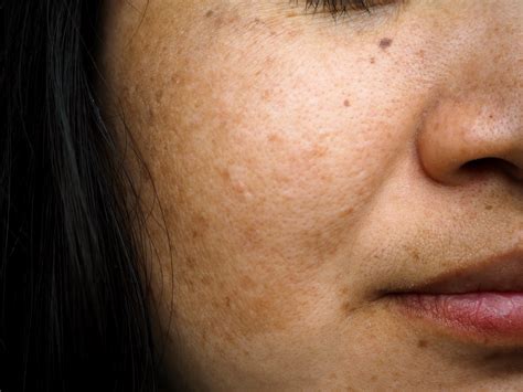 Tranexamic Acid More Effective Than Platelet-Rich Plasma for Melasma ...