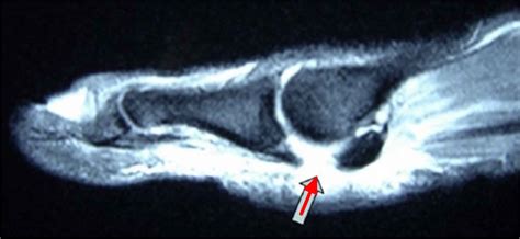 Turf toe causes, signs, symptoms, recovery, diagnosis & turf toe treatment