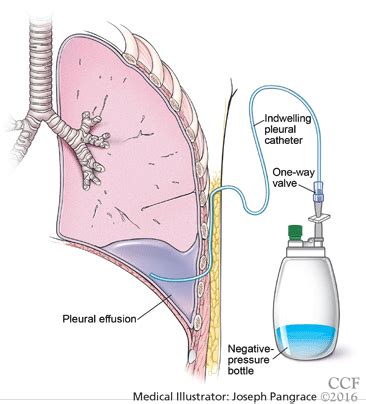 When should an indwelling pleural catheter be considered for malignant pleural effusion ...