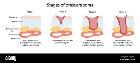 Canker Sore Stages