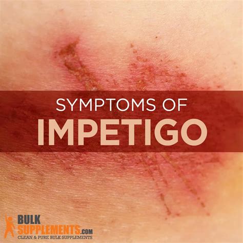 Impetigo: Symptoms, Causes & Treatment