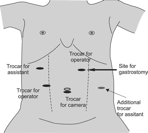 Laparoscopic Hiatal Hernia