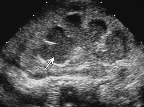 Pyelonephritis: Radiologic-Pathologic Review | RadioGraphics