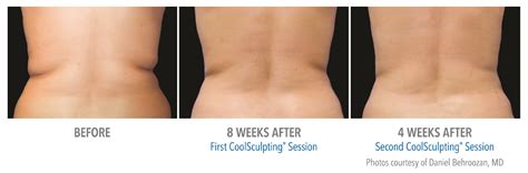 Coolsculpting - Rhett Women's CenterRhett Women's Center | Make Your Health A Priority