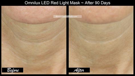 OmniLux LED Mask ~ 3 Month Results! Before & After Face, Neck, & Hand ...