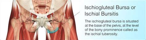 Ischiogluteal Bursitis Or Ischial Bursitis | Sports Injuries | Piriformis syndrome, Hip injuries