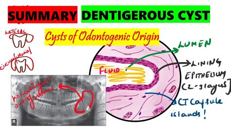 Dentigerous cyst | 10 minute SUMMARY | Histopathology | Clinical features | Radiographic ...