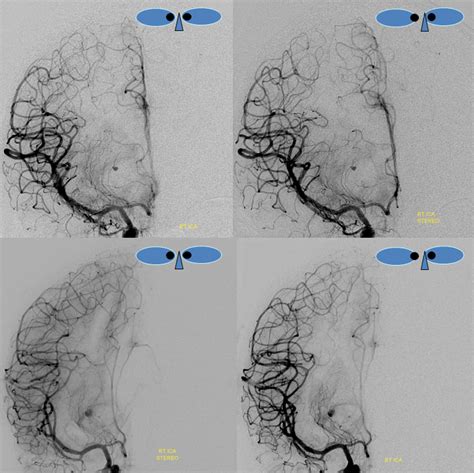 Introductory Brain Angiography | neuroangio.org