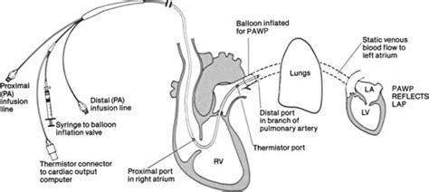 PA Catheter ports and placement | Catheter insertion, Catheter, Pulmonary