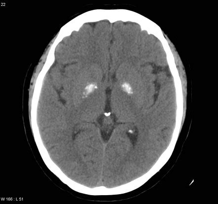 Normal intracranial calcifications | Radiology Reference Article | Radiopaedia.org