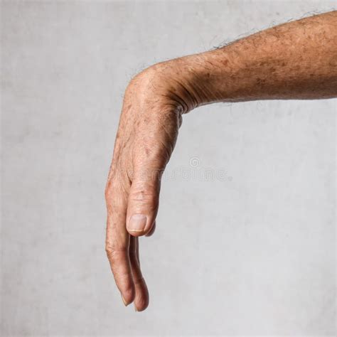 Radial Nerve Injury or Wrist Drop Stock Image - Image of finger, flex: 238886645