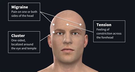 The facts about headaches | Complete Anatomy