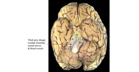 Tuberculous Meningitis - www.medicoapps.org