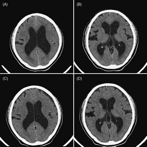 (A and B) Initially performed brain CT illustrates communicating ...