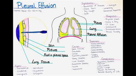 Understanding Pleural Effusion - Causes, Symptoms, Diagnosis, Treatment ...