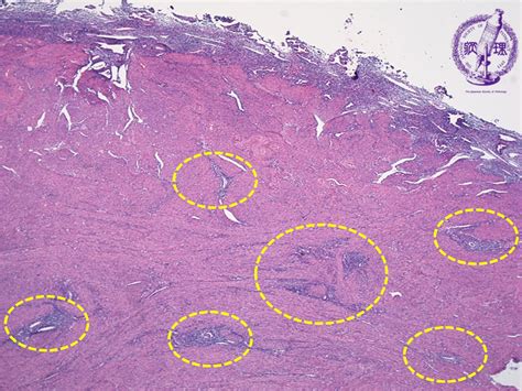 15.Female genital organs (2) Adenomyosis|Pathology Core Pictures