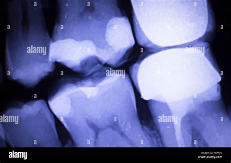 Tooth with filling dental x-ray close-up image showing teeth roots, gum disease and tooth decay ...