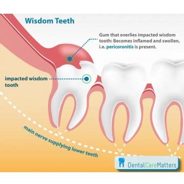 Wisdom Teeth Complications Headington | Extractions Oxford | Cowley