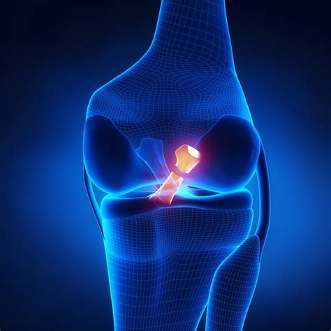 ACL Tears - Space Coast OrthopedicMerritt Orthopedics - Merritt Sports Medicine