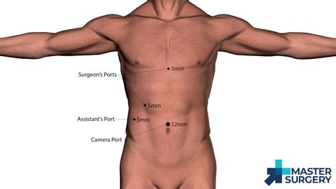 Laparoscopic Cholecystectomy – Master Surgery